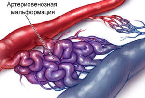 Лечение артериовенозных мальформаций в Израиле