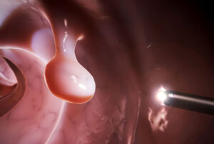 Лечение полипов желудка в Израиле