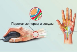 Лечение синдрома запястного канала в Израиле