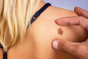 Лечение меланомы в Израиле