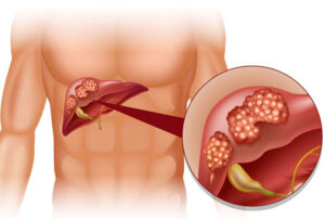 Лечение рака печени в Израиле