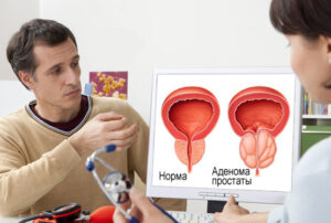 Лечение аденомы простаты в Израиле