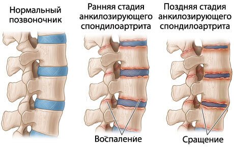 Болезнь Хаглунда-Шинца