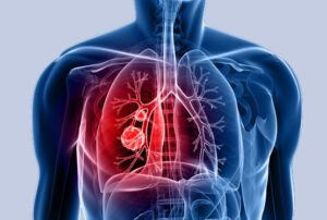 Лечение бронхопульмонального рака в Израиле