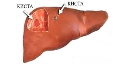 Киста почки: что это такое, чем опасна, симптомы, причины, виды, нормы, лечение, последствия