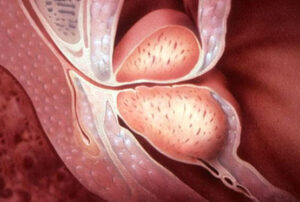 Лечение везикулита в Израиле