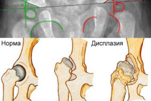 Лечение дисплазии тазобедренного сустава в Израиле