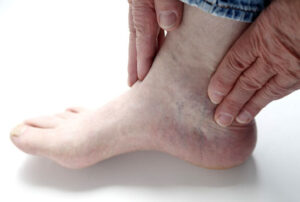 Лечение артрита голеностопного сустава в Израиле