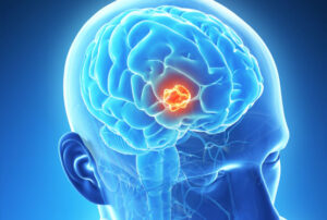 Лечение краниофарингиомы головного мозга в Израиле