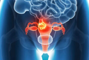 Лечение саркомы матки в Израиле