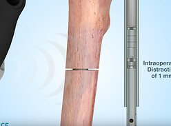 Новинка детской ортопедии — стержень Precice Nail для удлинения нижних конечностей без спиц
