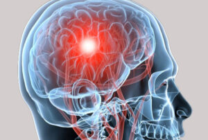 Лечение кисты головного мозга в Израиле