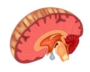Операции на головном мозге в Израиле