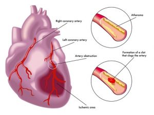 Ученые создали «живую заплатку» для сердца