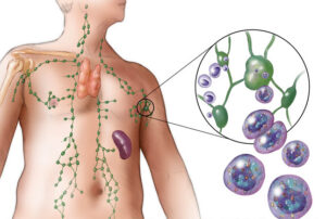 Лечение ангиоиммунобластной Т-клеточной лимфомы в Израиле