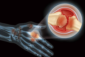 Лечение гемофильной артропатии в Израиле