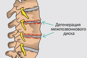 Лечение дегенерации межпозвонкового диска в Израиле